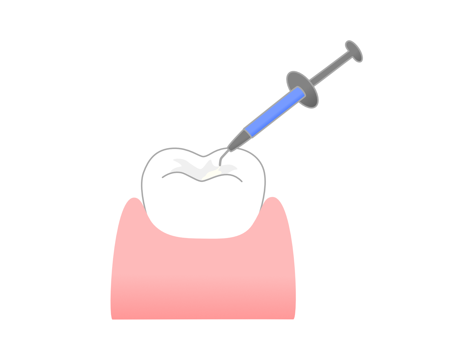 虫歯、歯周病の予防